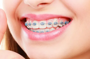 Choosing the Right Orthodontist: Key Considerations for Optimal Dental Treatment